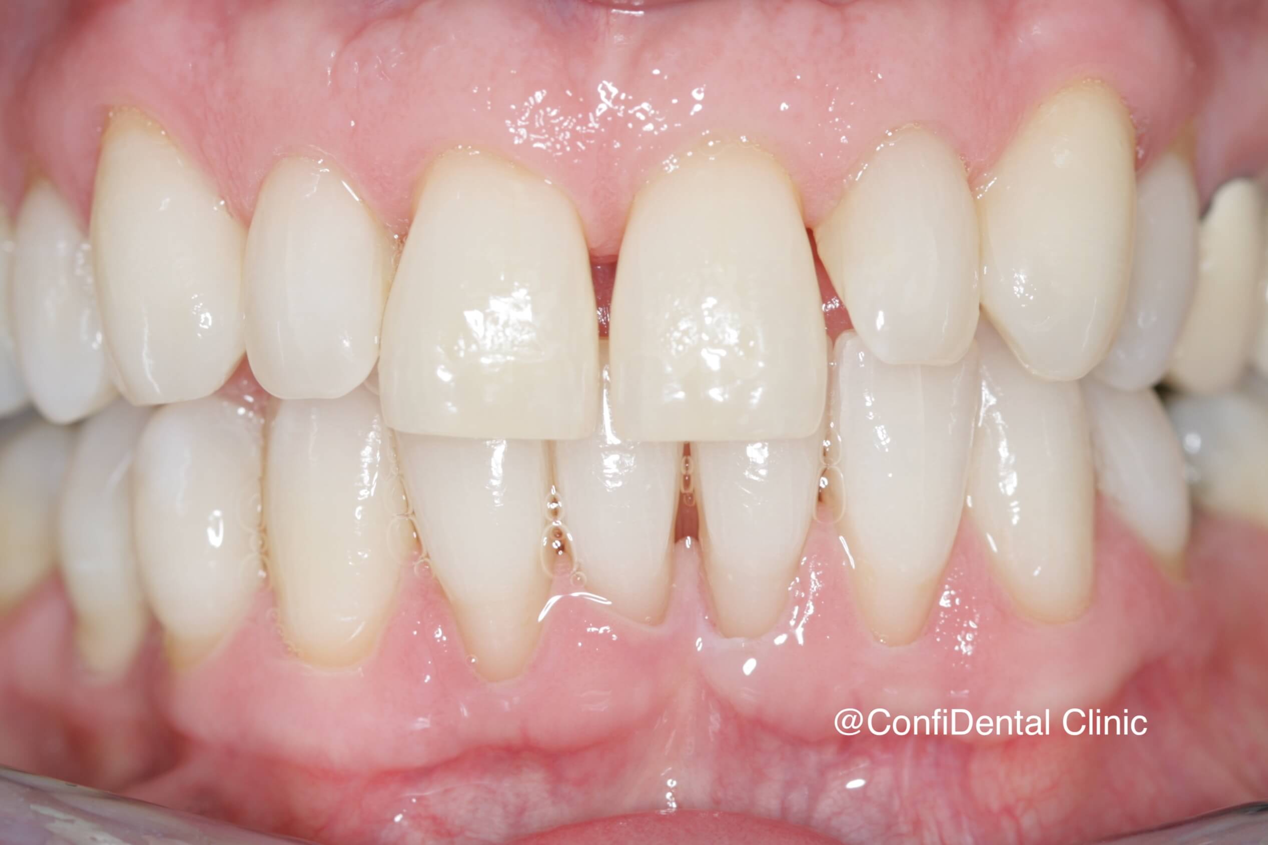 After treatment