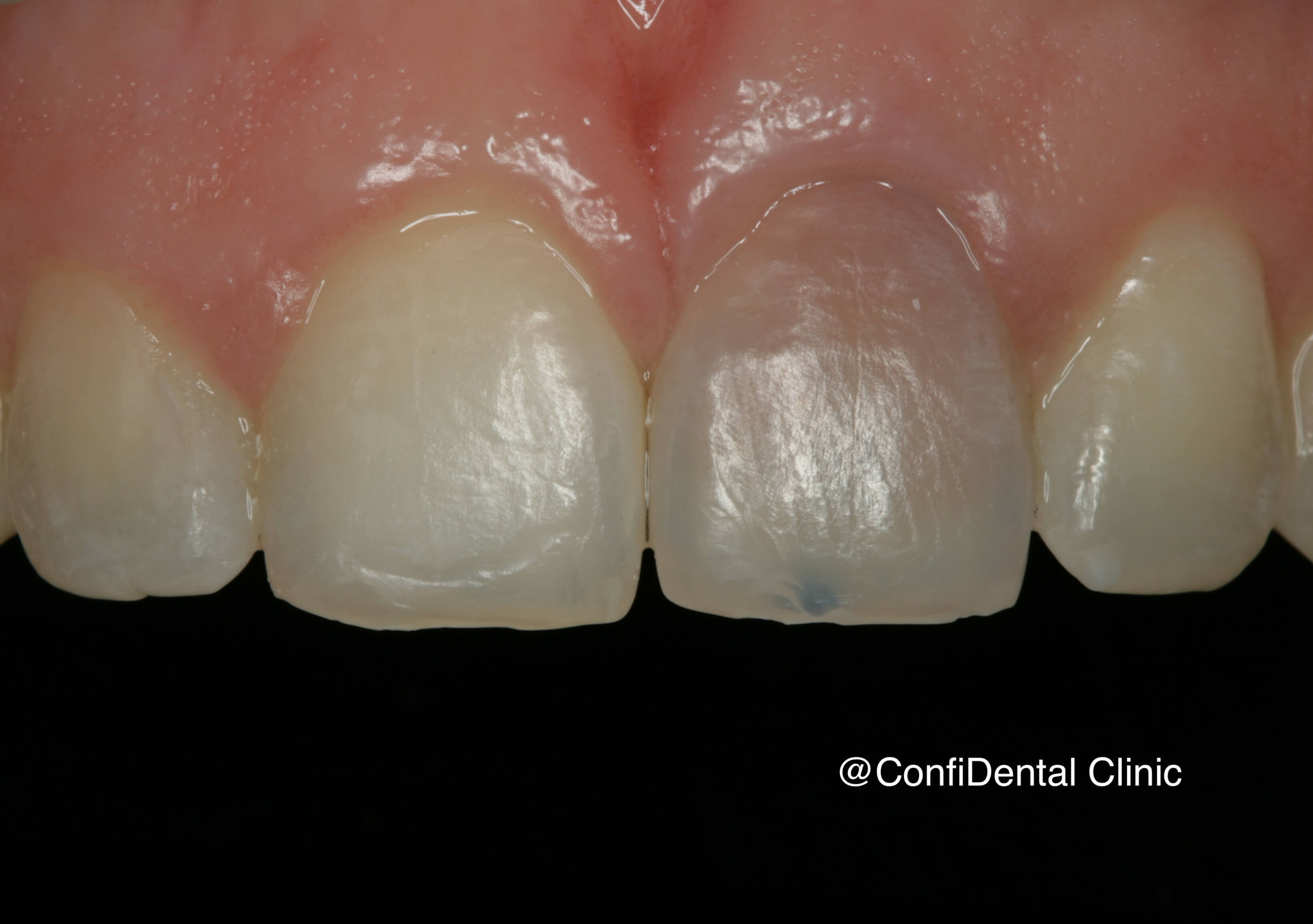 Before treatment