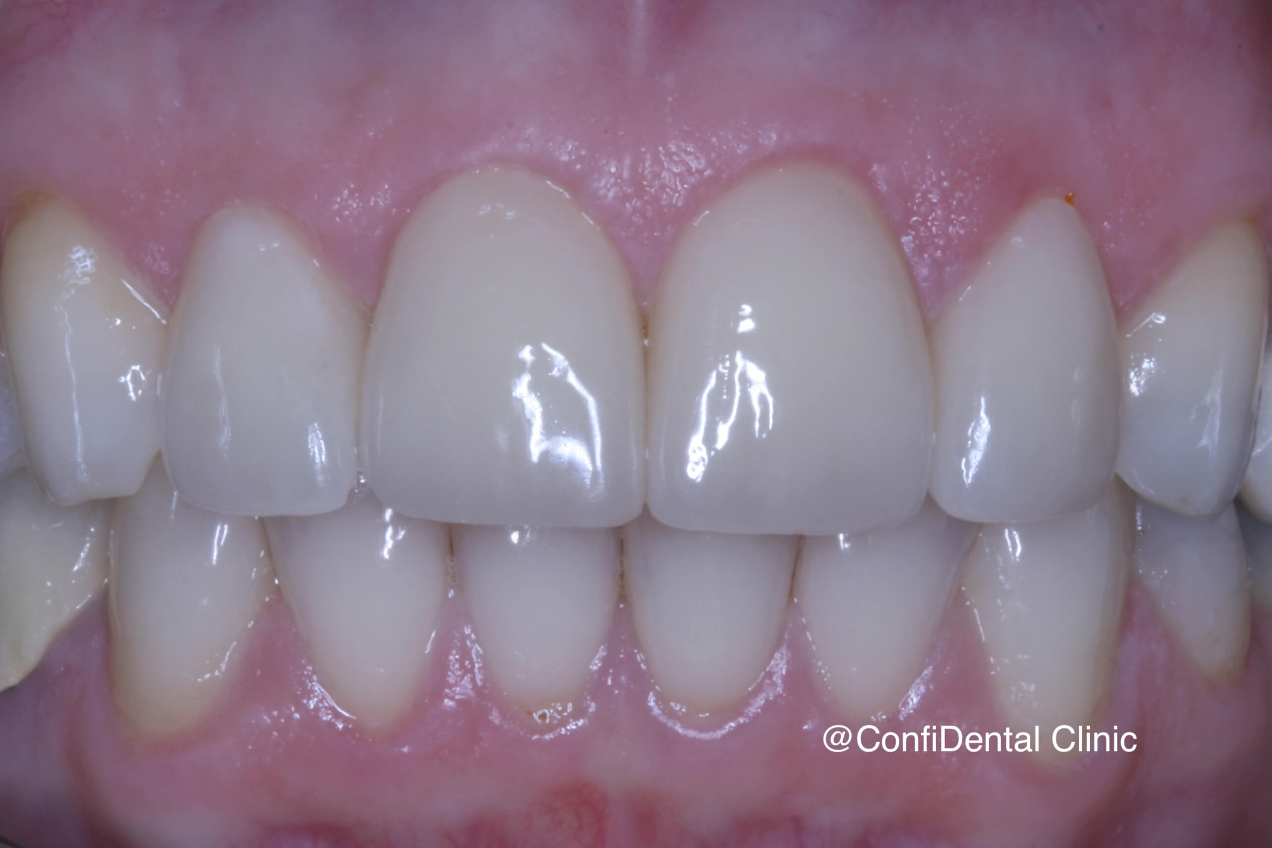 After treatment