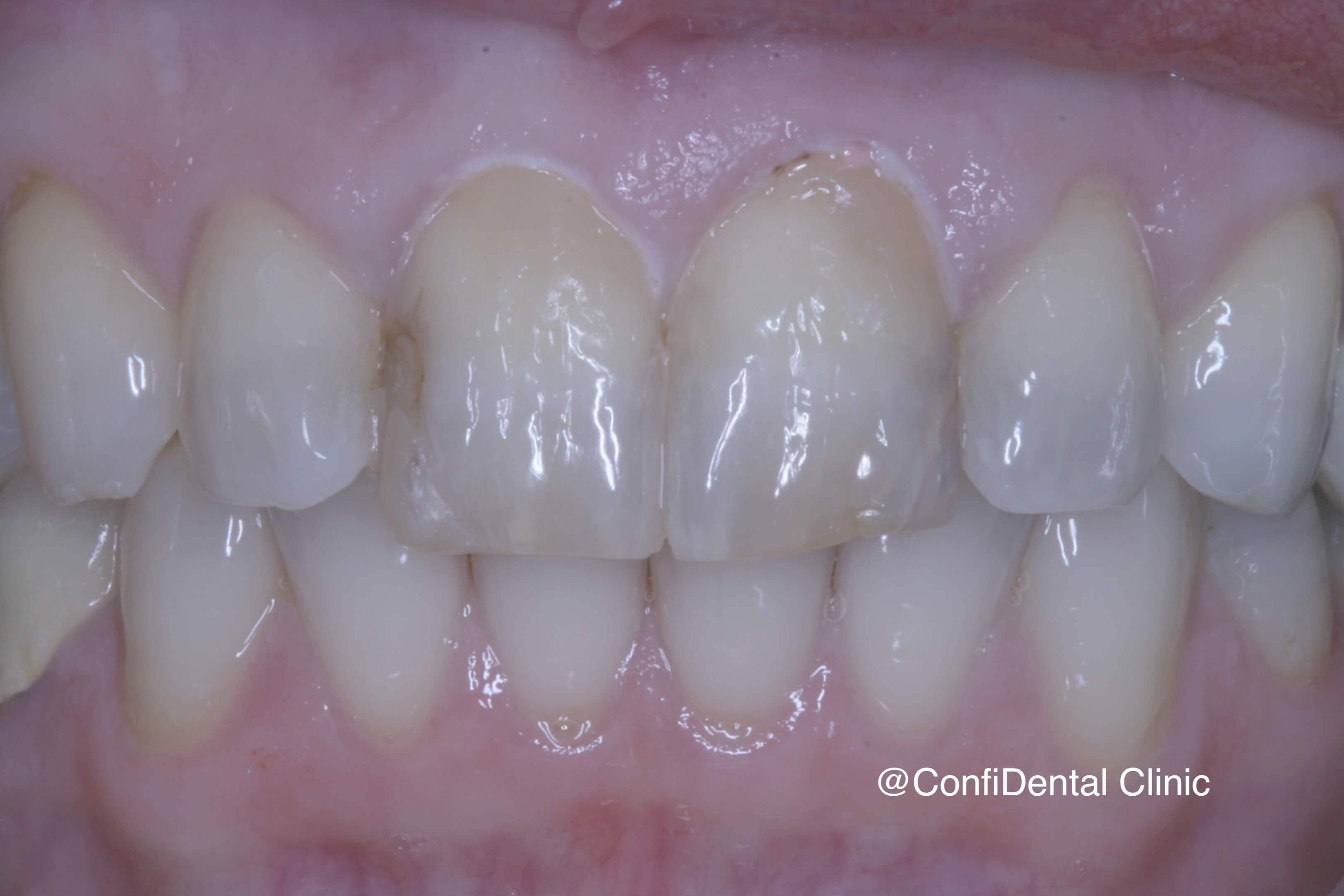 Before treatment